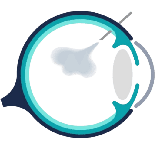 Intravitreal Injections (Anti-VEGF)